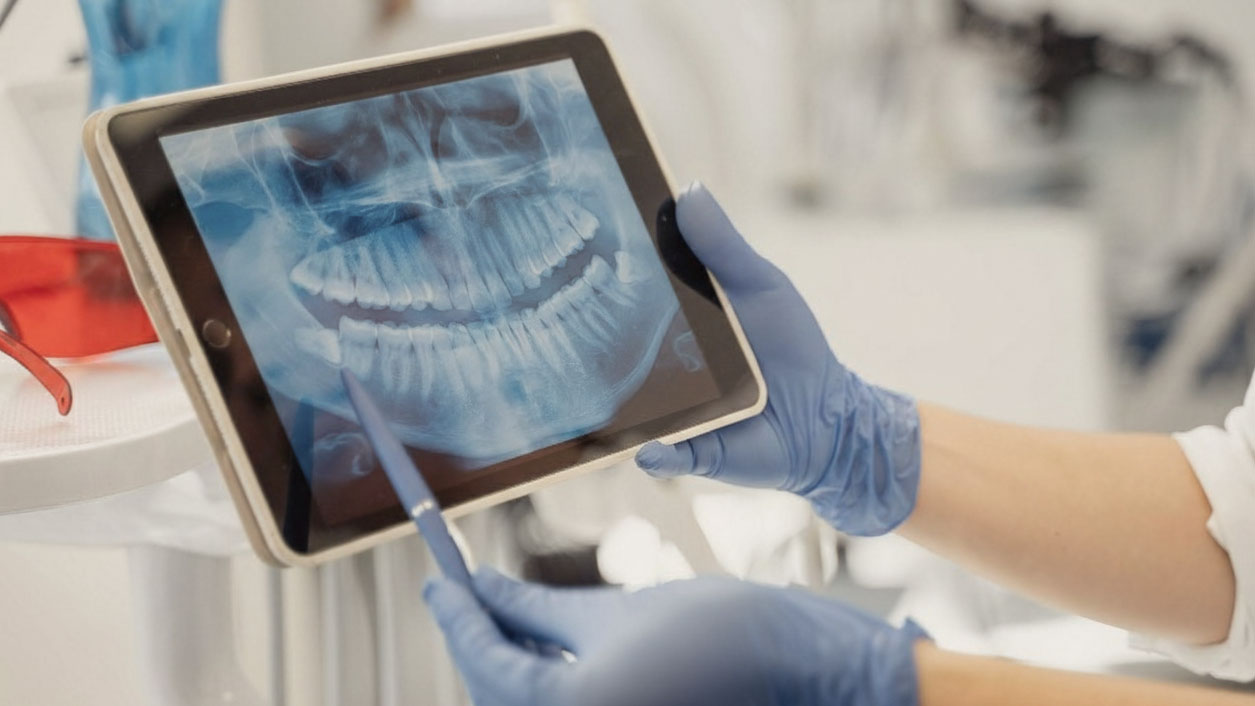 Freilegung von Zähnen – Um den Zahn dennoch kieferorthopädisch in seine eigentliche Position zu bewegen, wird der Zahn freigelegt und gleichzeitig mit einem Bracket beklebt.